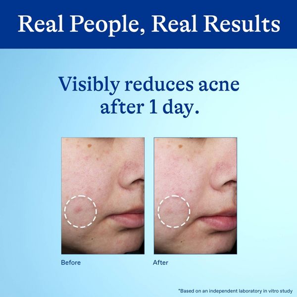Differin 10% Benzoyl Peroxide Acne Spot Treatment